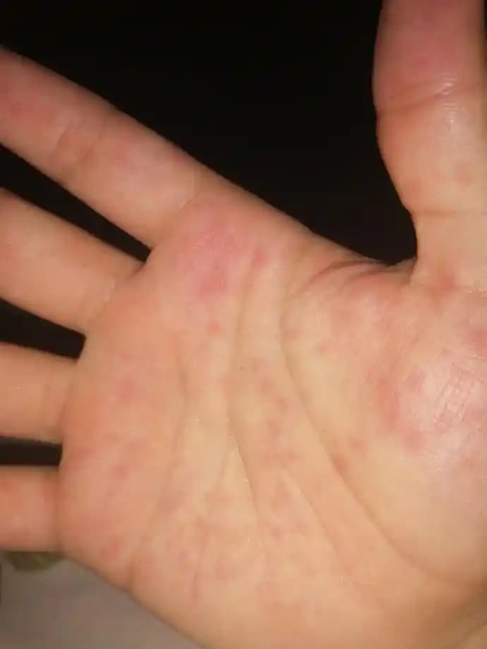 Elde Görünen Küçük Kırmızı Noktaların Nedenleri ve Doğru Bakım Yöntemleri