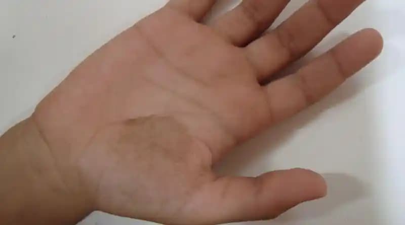 Elde Siyah Leke Nedenleri, Çözüm Yolları ve Doğal Bakım İpuçları