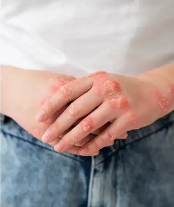 Ellerinizdeki Egzama için Doğru Kozmetik ve Cilt Bakım Yöntemleri