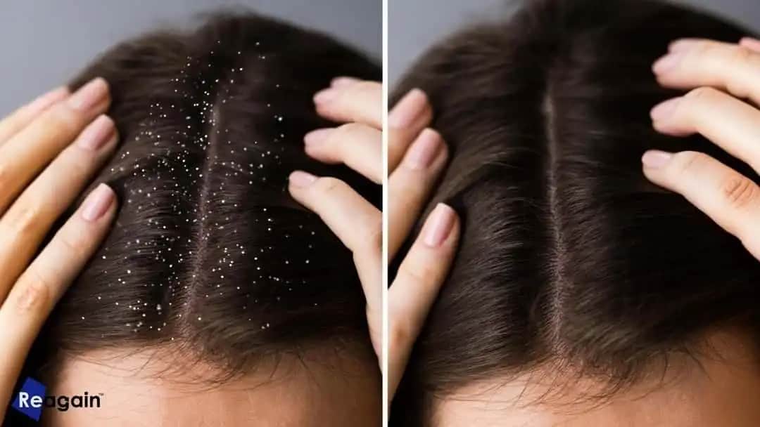 Erkekler İçin Kepekten Kurtulma Yolları: Sağlıklı ve Güzel Saçlar İçin Pratik Rehber