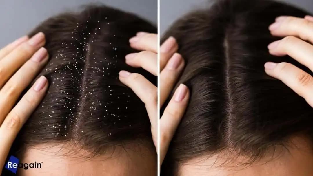 Erkekler İçin Kepekten Kurtulma Yolları: Sağlıklı ve Güzel Saçlar İçin Pratik Rehber