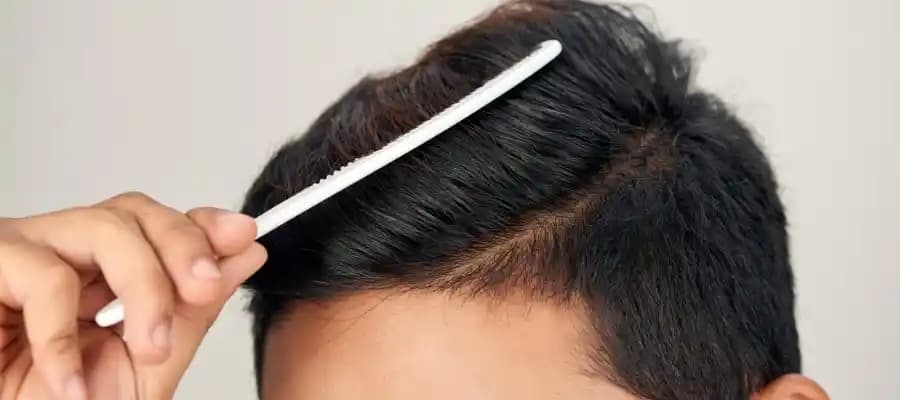 Erkeklerde Saç Yağlanmasının Nedenleri ve Etkili Çözüm Yolları Hakkında Kapsamlı Bilgi