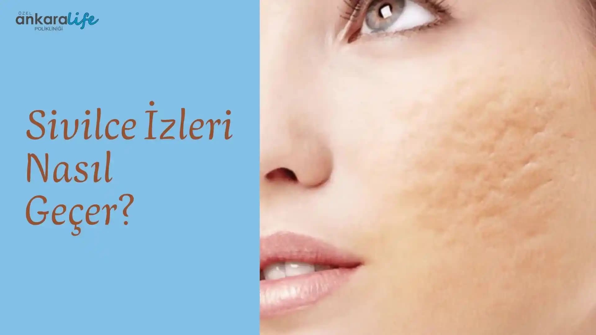 Eski Sivilce İzleri Nasıl Geçer: Etkili Yöntemler ve Uzman Tavsiyeleri Rehberi