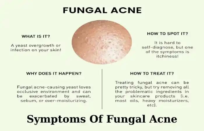 Fungal Akne Nedir, Belirtileri, Nedenleri ve Etkili Tedavi Yöntemleri