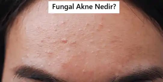 Fungal Akne Tedavisinde Etkili İlaçlar ve Bakım Yöntemleri Rehberi