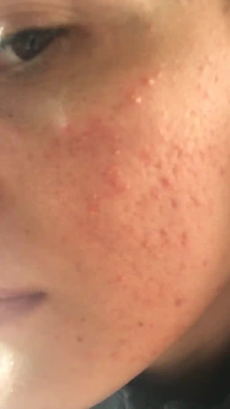 Fungal Sivilce Nedir, Belirtileri ve Etkili Tedavi Yöntemleri Hakkında Bilgiler