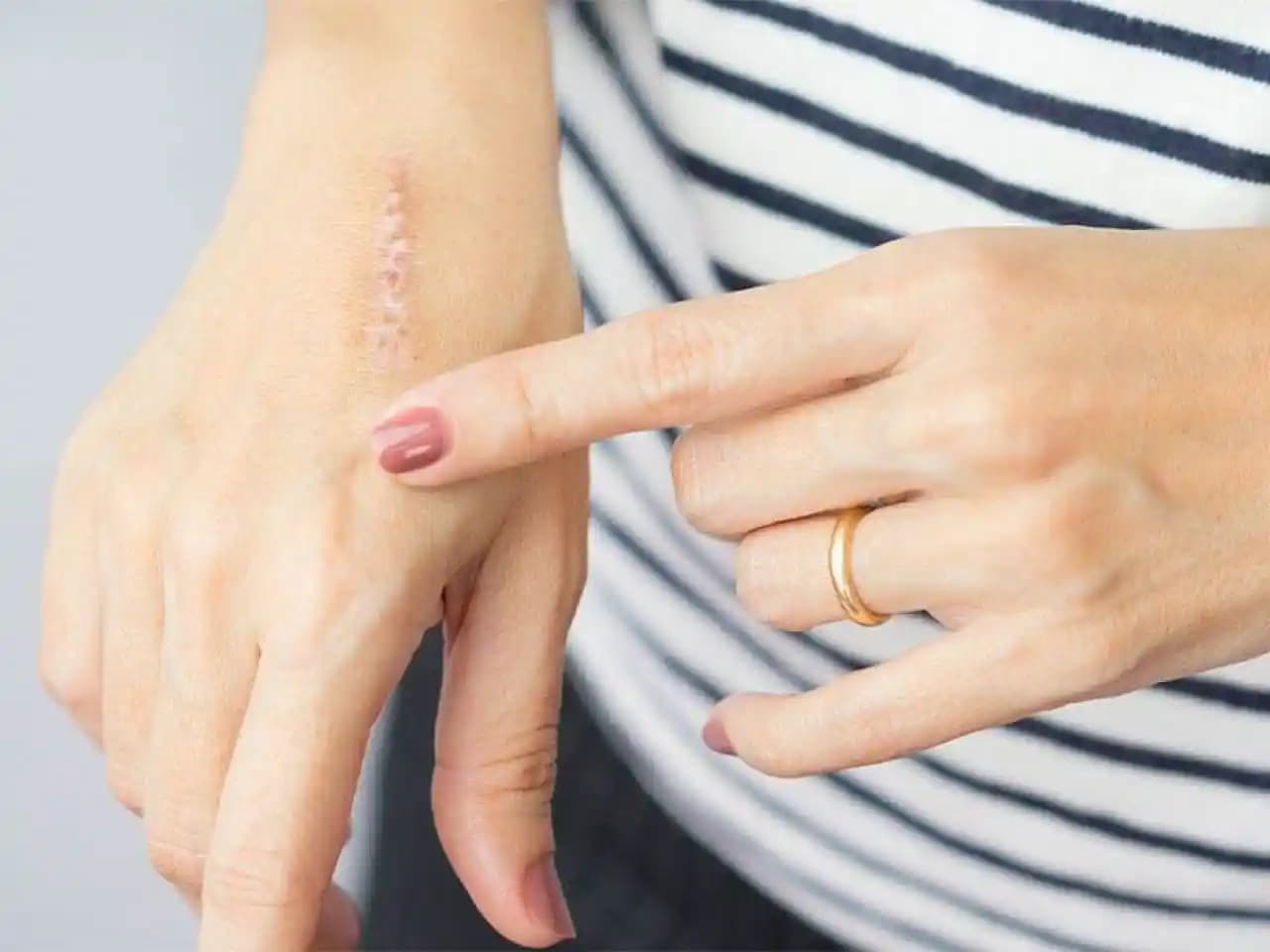 Geçmeyen Yara İzleri ve Kozmetik Çözümler: Estetik ve Psikolojik Etkilerin Yönetimi