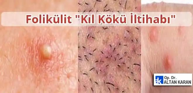 Genital Bölgede İltihaplı Batıklar: Nedenleri, Belirtileri ve Etkili Çözüm Yolları