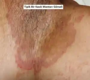 Genital Bölgedeki Egzama İçin Bilinçli Bakım ve Etkili Çözüm Yolları