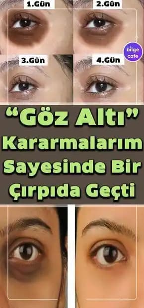 Göz Altı Beyazlatma Yöntemleri ve Doğal Çözümler Hakkında Bilmeniz Gerekenler