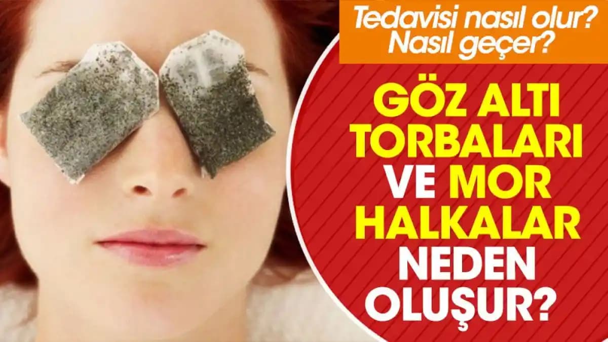 Göz Altı Halkalarının Nedenleri ve Azaltma Yöntemleri Hakkında Bilgiler