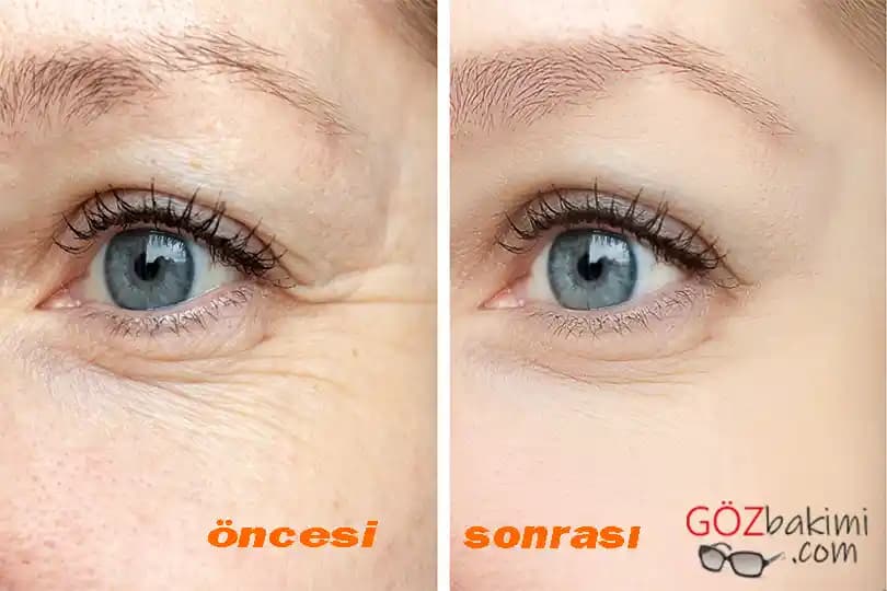 Göz Altı İnce Çizgilerine Karşı Etkili Çözüm Yöntemleri ve Bakım İpuçları