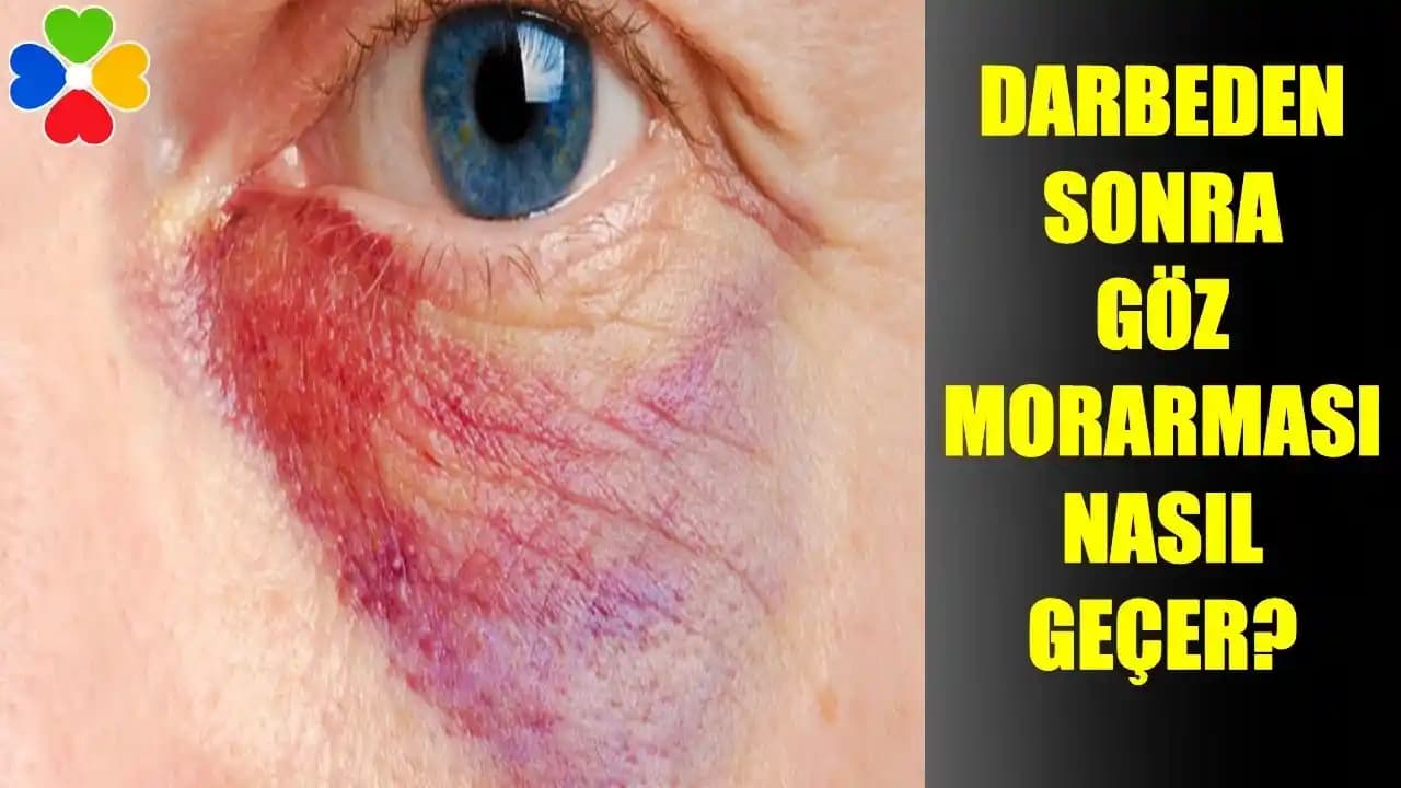Göz Altı Morarması Nedenleri ve Etkili Çözüm Yolları Hakkında Kapsamlı Bilgi