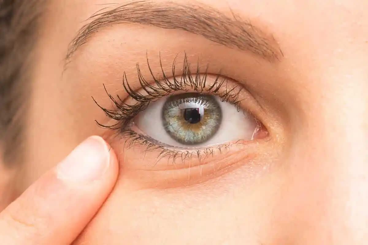 Göz Altı Morlukları Nasıl Geçer? Etkili Çözüm Yolları ve İpuçları