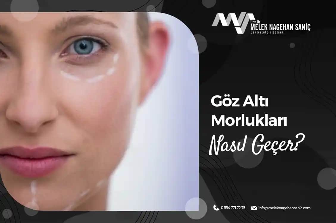Göz Altı Morlukları Nasıl Geçer: Nedenleri ve Etkili Çözüm Yöntemleri
