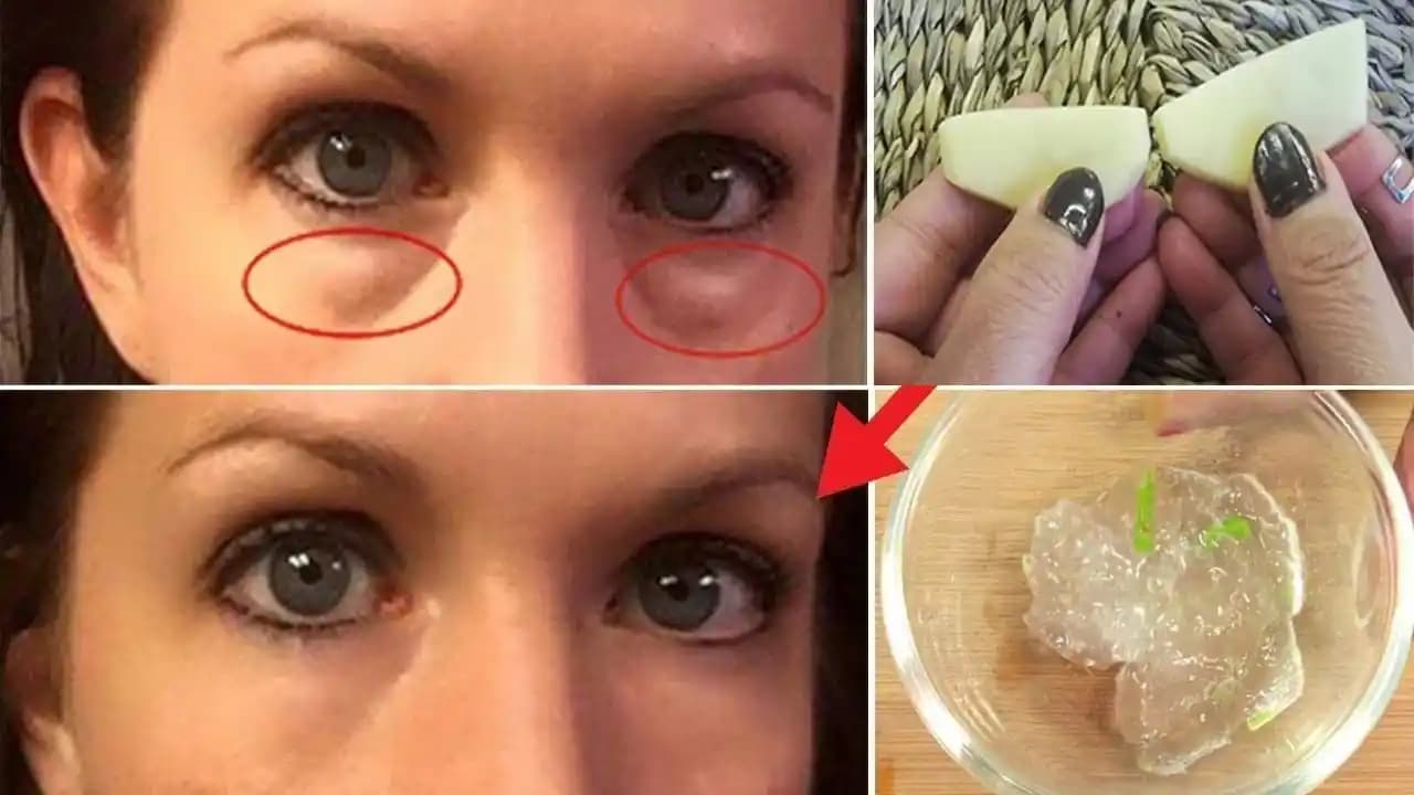 Göz Altı Morlukları ve Torbalarını Azaltmak İçin Etkili Yöntemler ve Tedavi Seçenekleri