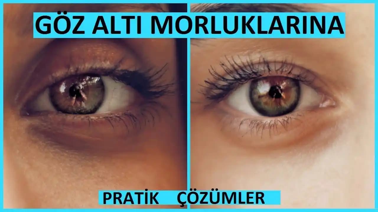 Göz Altı Morluklarını Azaltmak İçin Etkili Yöntemler ve Günlük Bakım İpuçları