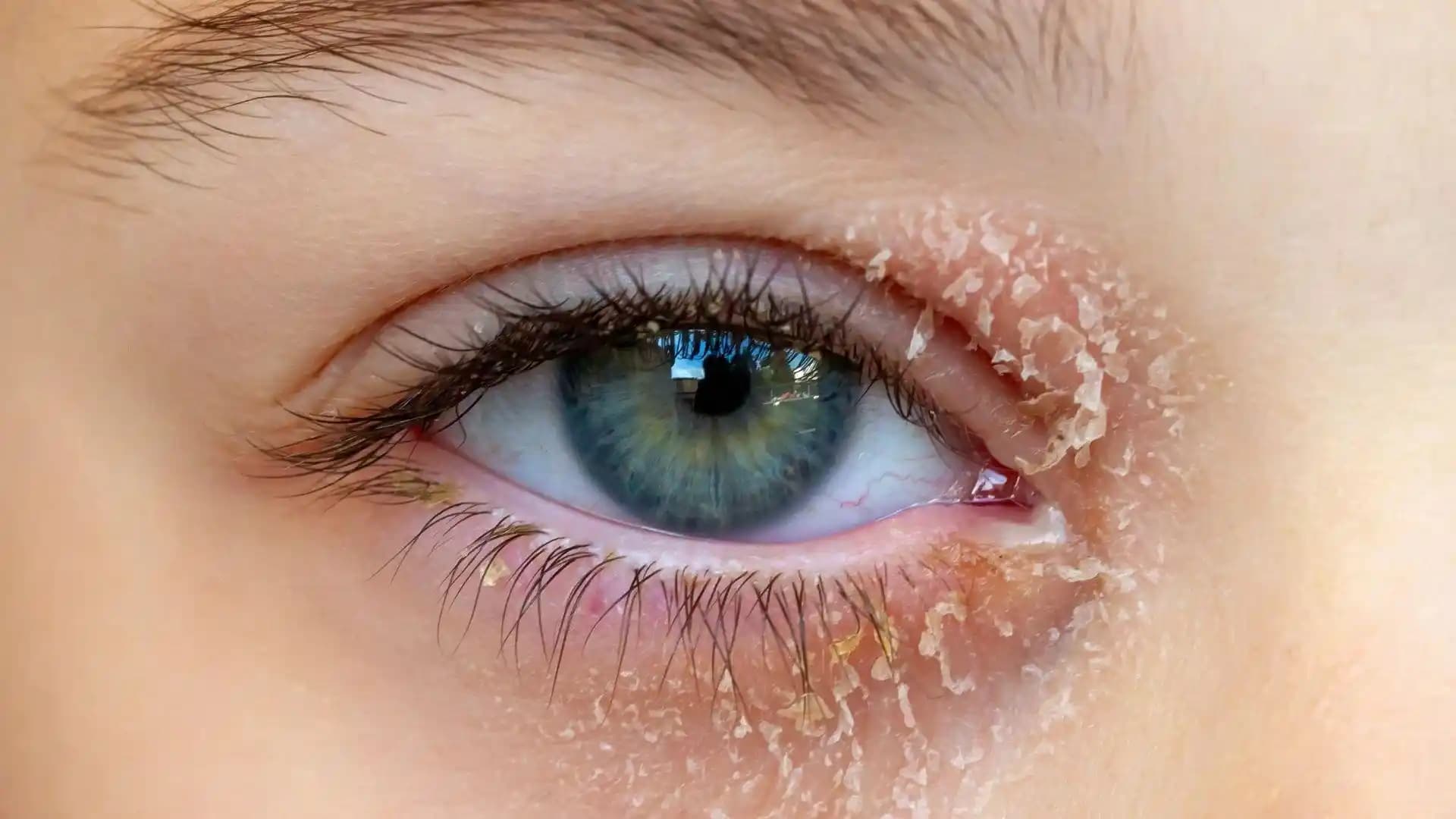 Göz Egzaması Nedir, Belirtileri ve Kozmetik Ürünlerle Bakım Yöntemleri