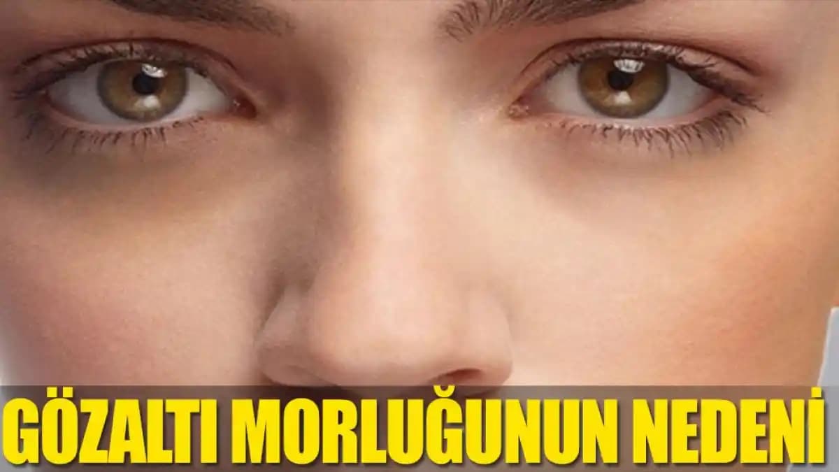 Göz Etrafı Morarmalarının Nedenleri ve Kozmetik Çözüm Yöntemleri