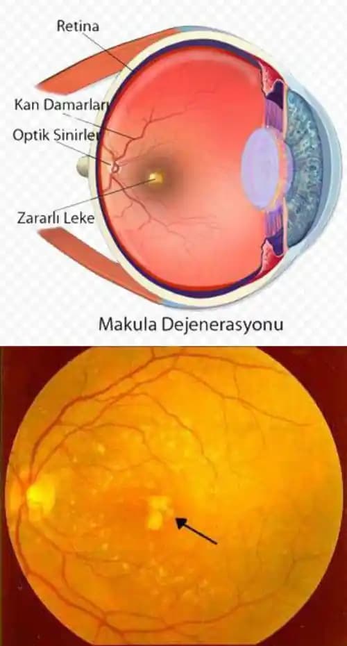 Göz İçinde Sarı Leke Nedenleri ve Alınabilecek Önlemler Hakkında Bilgiler