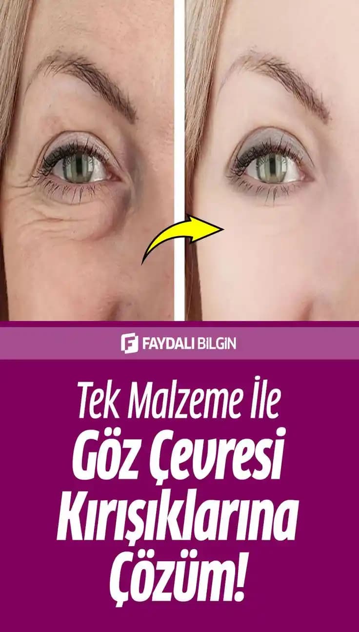 Göz Kenarı Kırışıklıklarını Azaltma Yöntemleri ve Cilt Sağlığı İçin Tavsiyeler