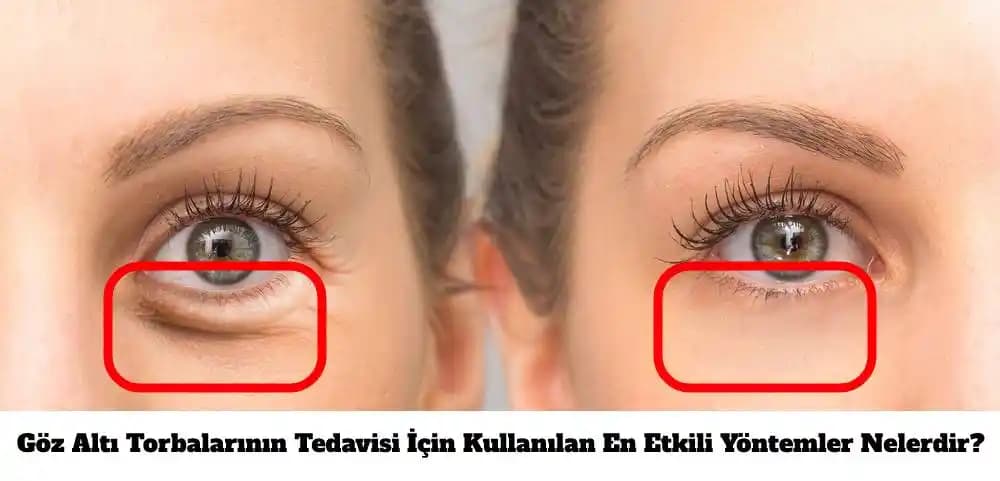 Göz Torbaları Neden Olur ve Göz Altı Şişliklerini Azaltmanın Etkili Yolları