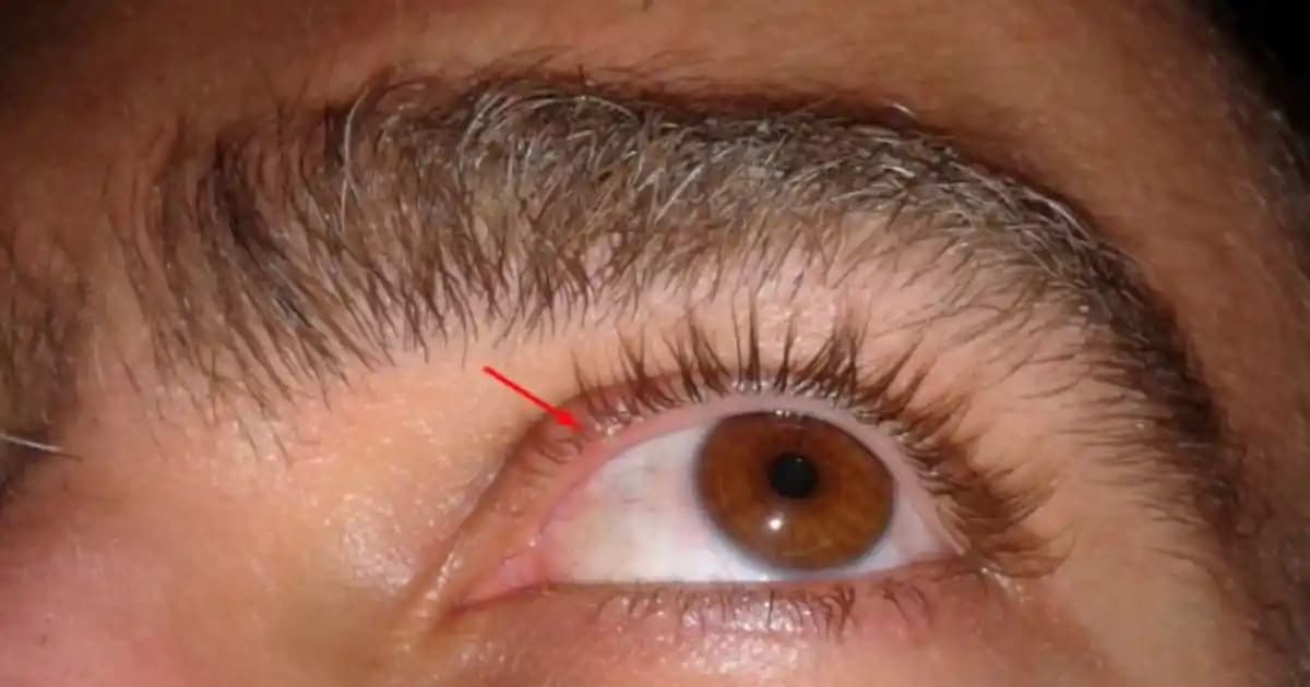 Göz Üstü Sivilce Nedenleri ve Cilt Sağlığını Koruma Yöntemleri