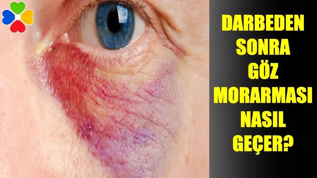 Gözde Morarma Nedenleri, Belirtileri ve Korunma Yöntemleri Hakkında Detaylı Bilgi