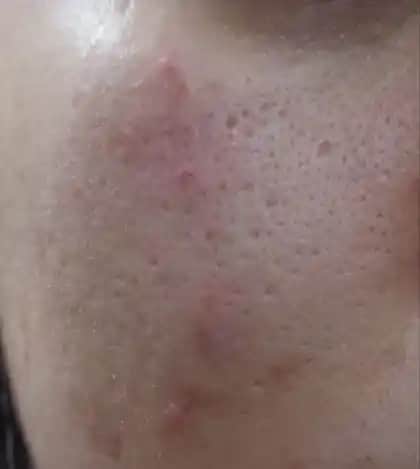 Gözenekleri Genişleyen Ciltler İçin Etkili Bakım ve Doğal İpuçları Rehberi