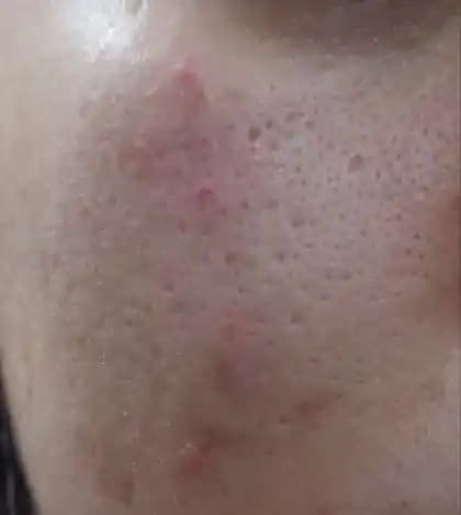 Gözenekleri Genişleyen Ciltler İçin Etkili Bakım ve Doğal İpuçları Rehberi