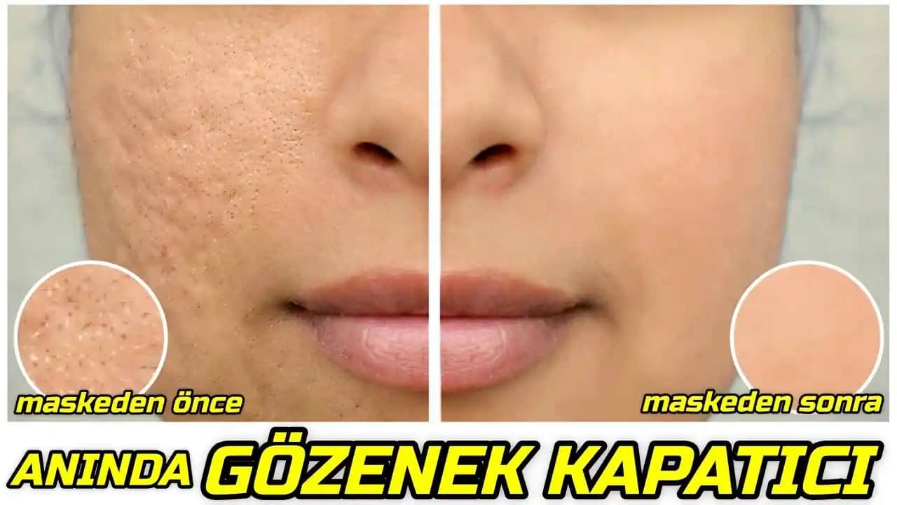 Gözenekleri Kapama ve Sıkılaştırma Yöntemleri Cilt Sağlığı İçin Bilimsel ve Doğal Çözümler