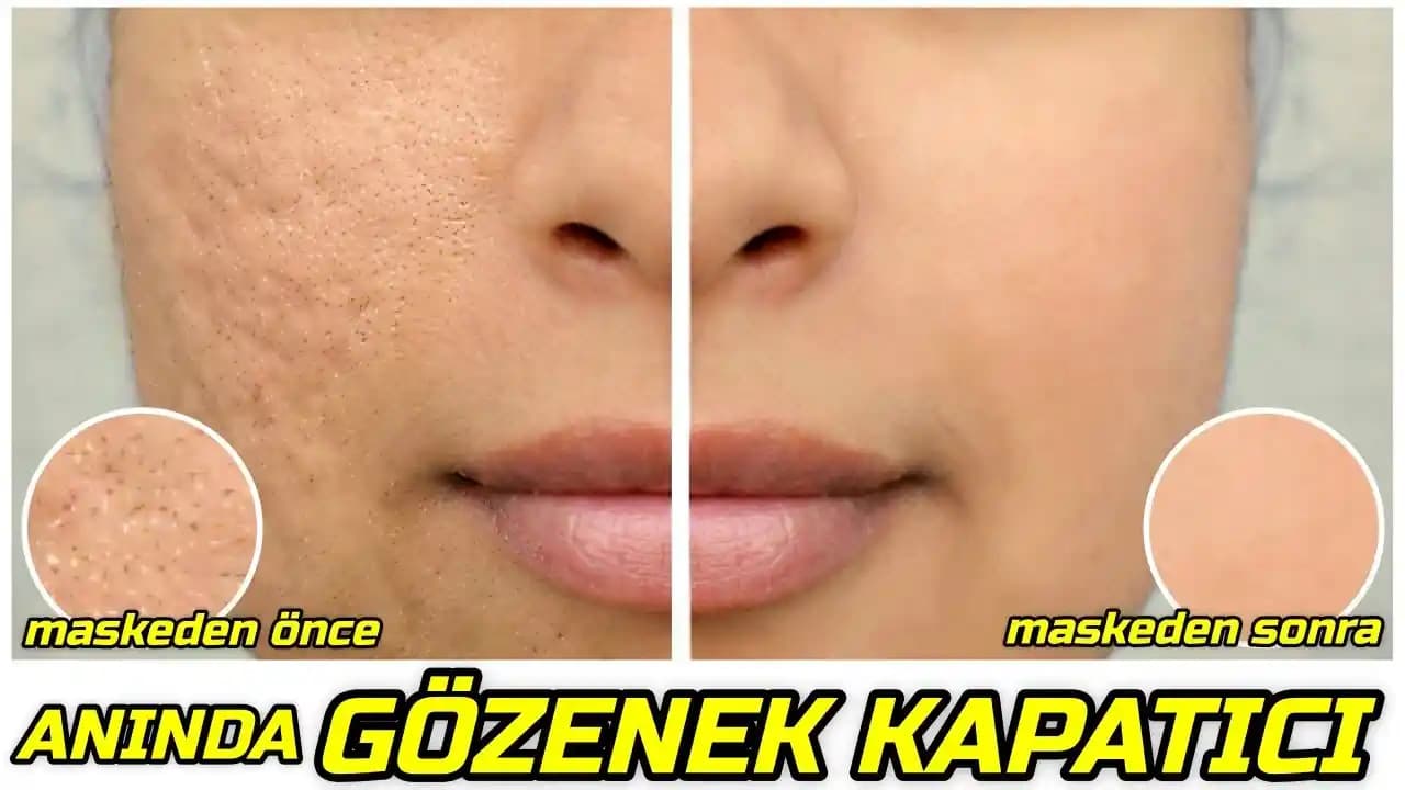 Gözenekleri Küçültme ve Cilt Sağlığını Koruma Yöntemleri