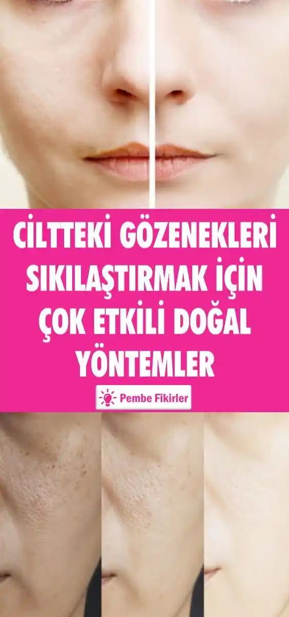 Gözeneklerin Açık Olmasının Nedenleri ve Etkili Çözüm Yolları