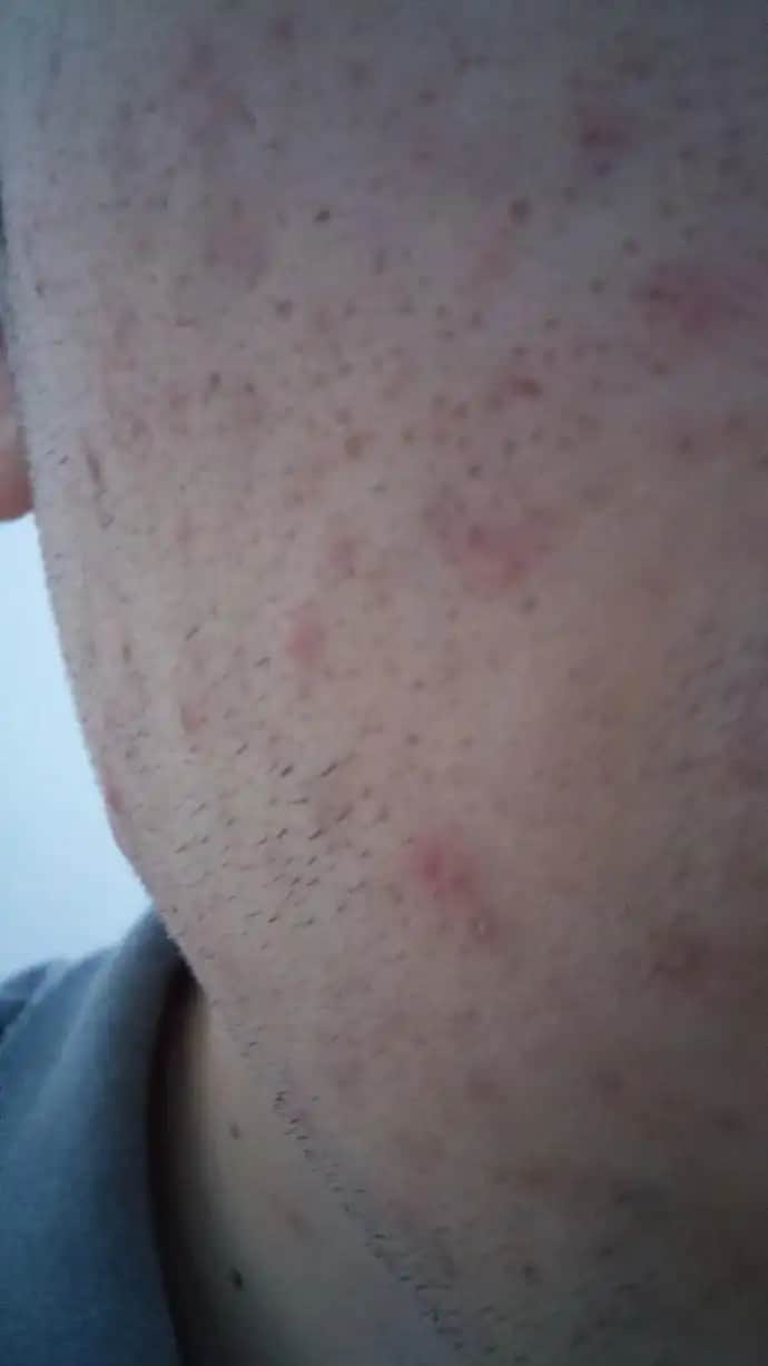 Gözeneklerin Açılma Nedenleri ve Cilt Sağlığı İçin Alınabilecek Önlemler