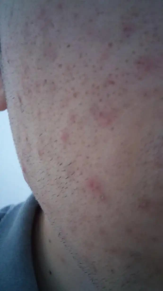 Gözeneklerin Açılma Nedenleri ve Cilt Sağlığı İçin Alınabilecek Önlemler