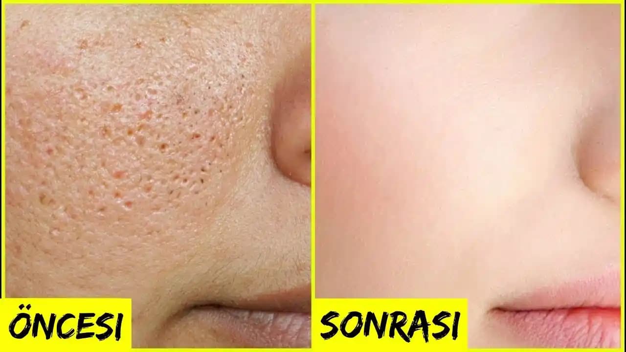 Gözeneklerin Görünümünü İyileştirme ve Sıkılaştırma Yöntemleri