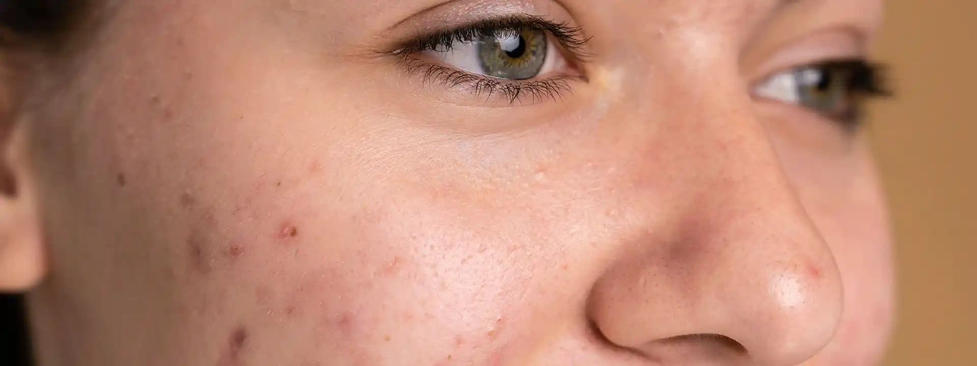 Gözeneklerin Nedenleri ve Sağlıklı Kalma Yöntemleri Rehberi