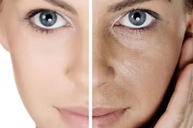 Gözenekli Cilt Tedavisi ve Sıkılaştırma Yöntemleri Hakkında Kapsamlı Rehber