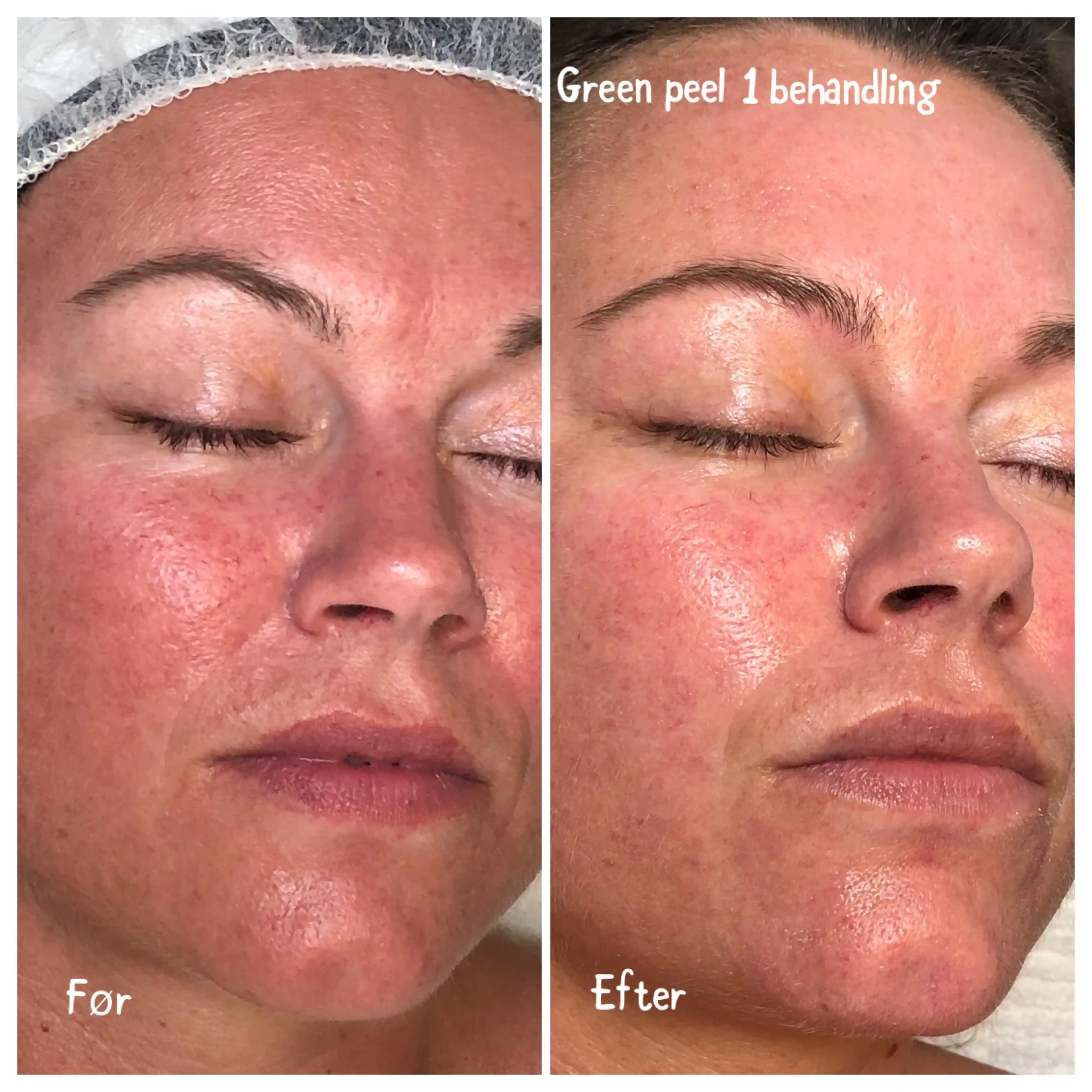 Green Peeling Nedir Cilt Yenileme İçin Doğal ve Güvenilir Bir Yöntem