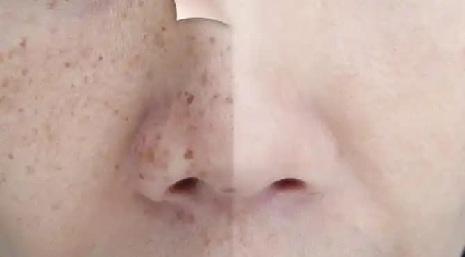 Güneş Kaynaklı Kırmızı Lekeler ve Kozmetik Çözümlerle Cilt Koruma Yöntemleri