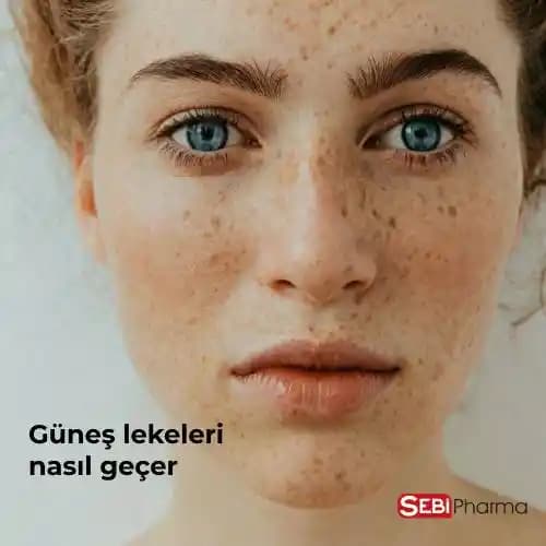 Güneş Lekeleri Nasıl Geçer? Kozmetik Yaklaşımlar ve Güncel Çözümler