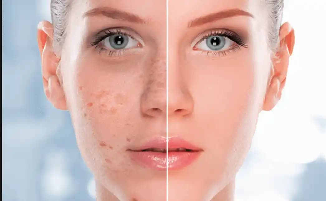 Güneş Lekeleriyle Mücadele: Koruma, Tedavi ve Doğal Çözüm Yöntemleri