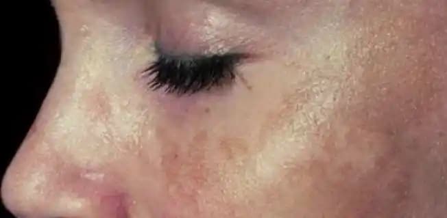 Güneş Yanığı Lekeleri: Nedenleri, Tedavi Yöntemleri ve Korunma İpuçları