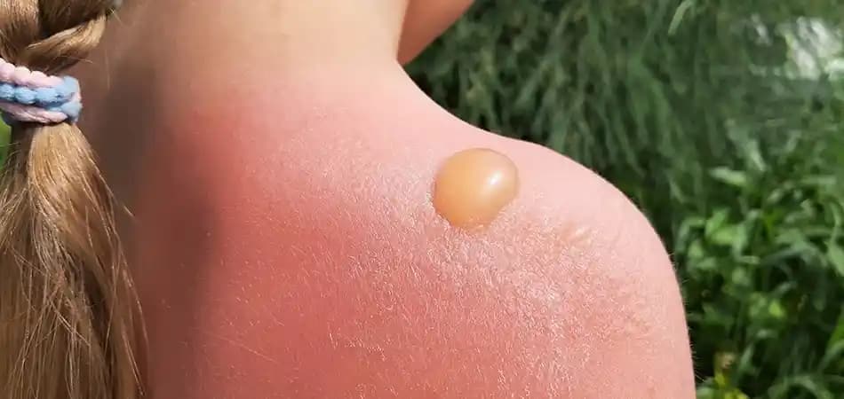 Güneş Yanığına Karşı Doğru Kozmetik Yaklaşımlar ve Cilt Bakımı İpuçları