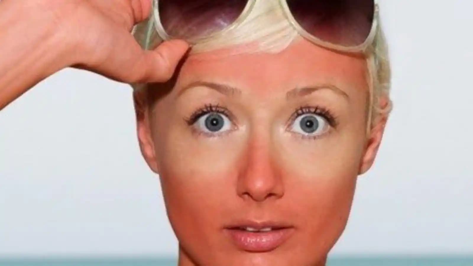 Güneşte Kızaran Yüzler İçin Etkili Bakım Yöntemleri ve Doğal Çözümler