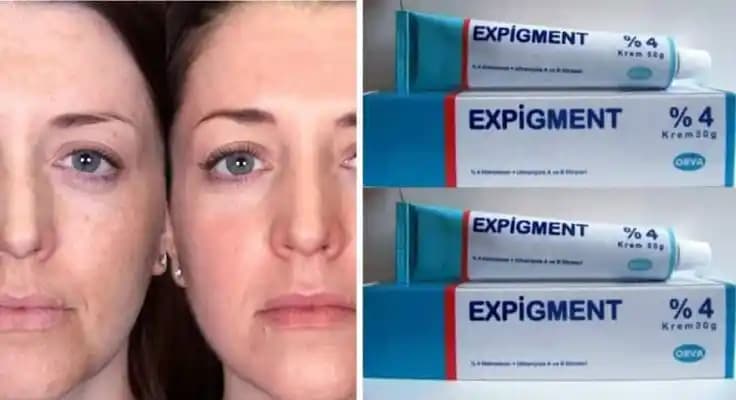 Hamilelikte Cilt Lekeleri İçin Güvenilir ve Etkili Kremler Rehberi