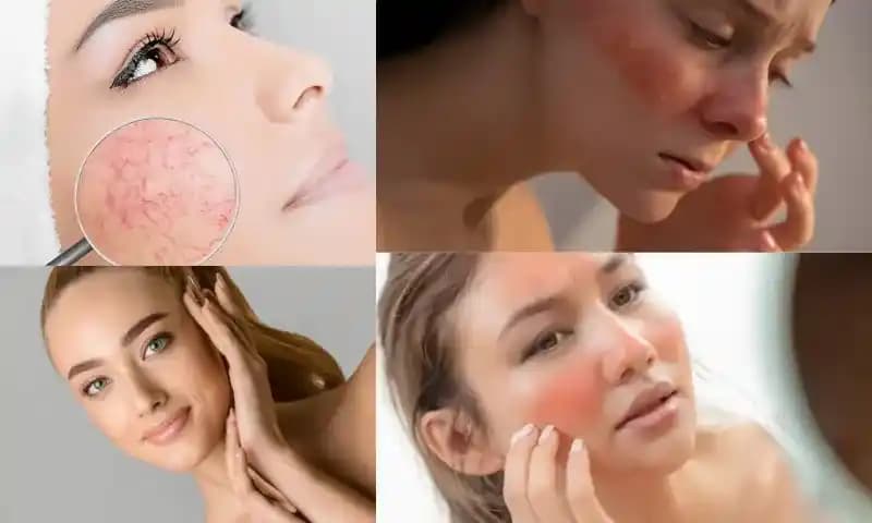 Hassas Cilt Belirtileri ve Doğru Bakım Yöntemleri Rehberi