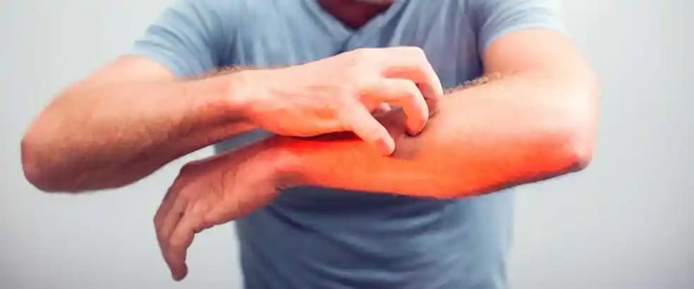 Havuz Sonrası Kaşıntıya Karşı Etkili Çözümler ve Koruyucu Önlemler