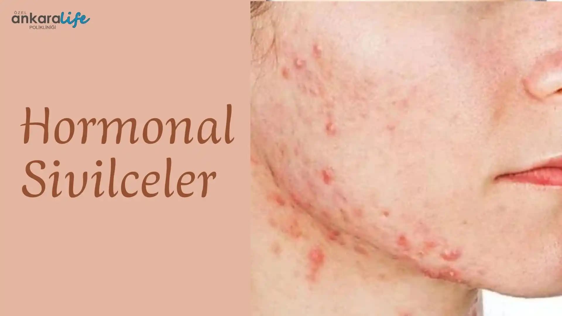 Hormon Bozukluğundan Kaynaklanan Sivilceler ve Tedavi Yöntemleri