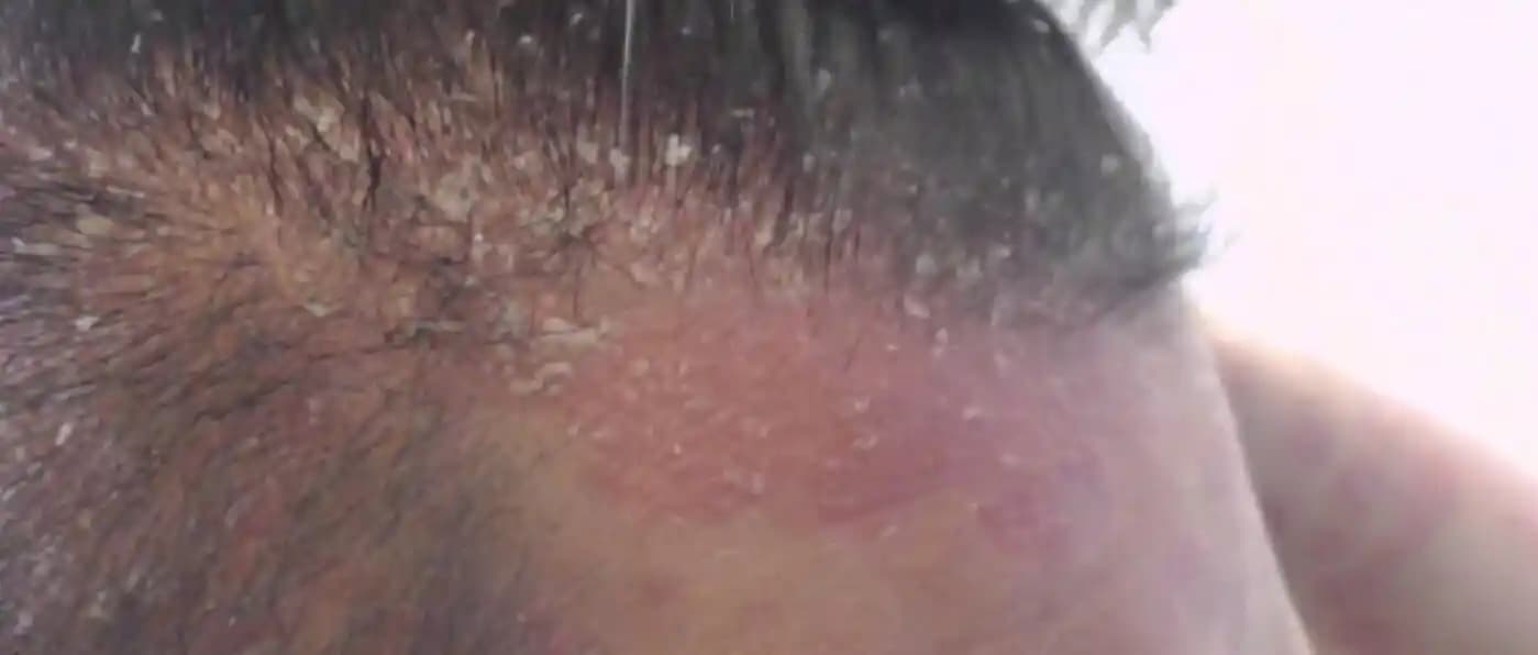 Kafa Derisinin Kaşınmasının Nedenleri ve Etkili Çözüm Yolları